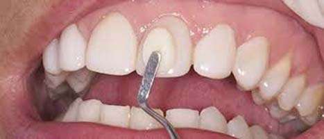 Amalgamas dentales