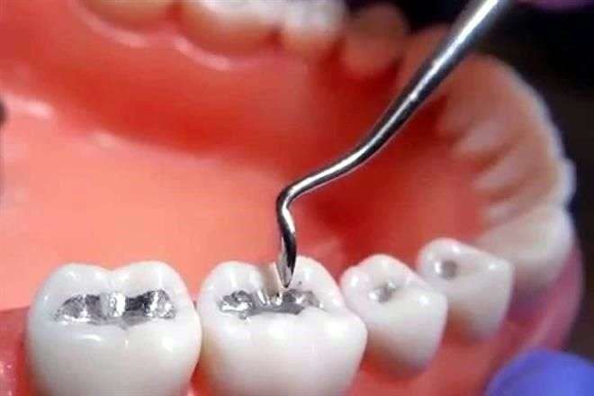 Amalgamas dentales