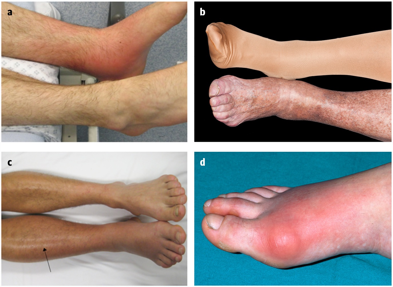 ¿Como diferenciar la celulitis de otras causas de "piernas rojas"?