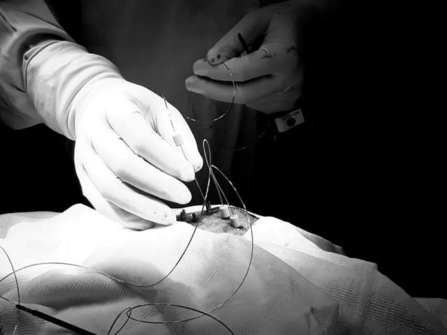 el equipo de cirugia de epilepsia del Hospital Español de Mendoza