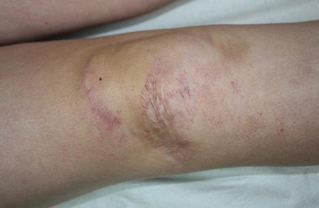 Sindromes de Ehlers-Danlos - Artículos Sindromes de Ehlers-Danlos - Artículos