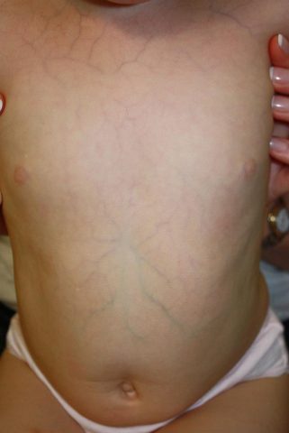 Sindromes de Ehlers-Danlos - Artículos Sindromes de Ehlers-Danlos - Artículos
