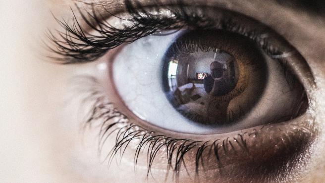 La aniridia es la ausencia total o parcial del iris del ojo.