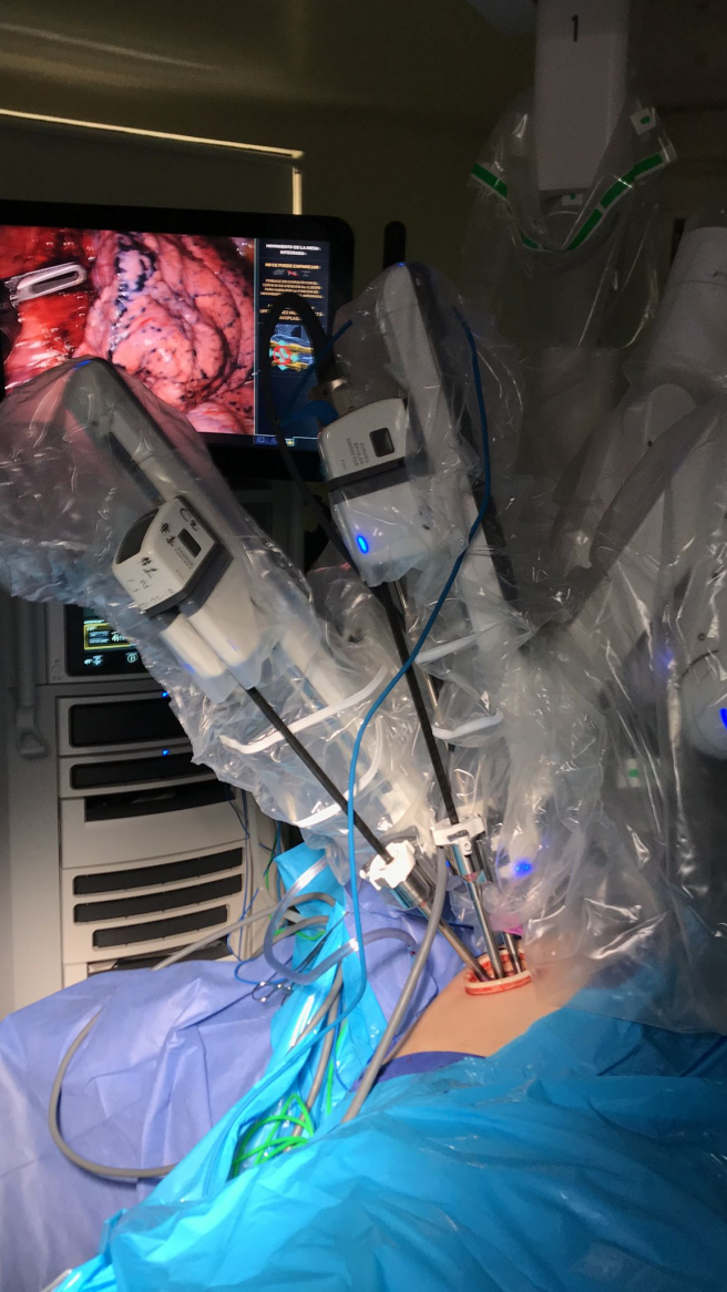 Imagen de una cirugía uniportal con el robot Da Vinci de cinco brazos.