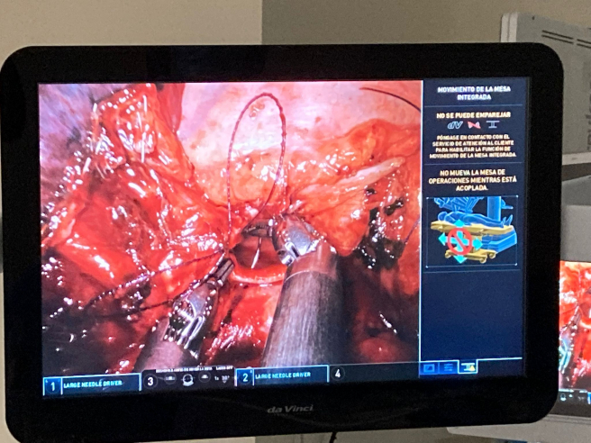 Reconstrucción bronquial con el robot Da Vinci uniportal.