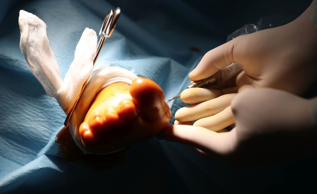Clinica Podologica Ayesa, expertos en cirugia de minima incision