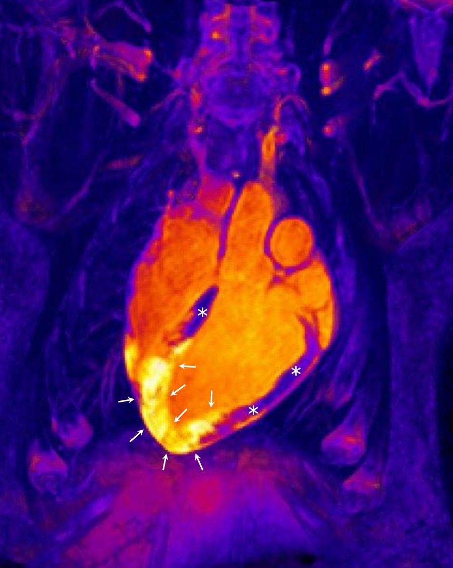 Corazon tras un infarto agudo de miocardio