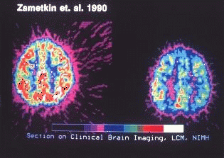 Actividad metabolica cerebral en personas sin TDAH (izquierda) y con el (derecha).