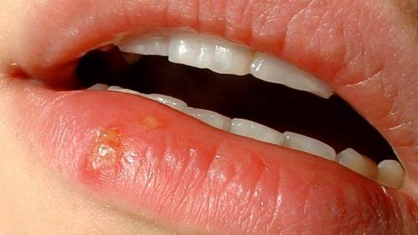 Ejemplo de un herpes labial.