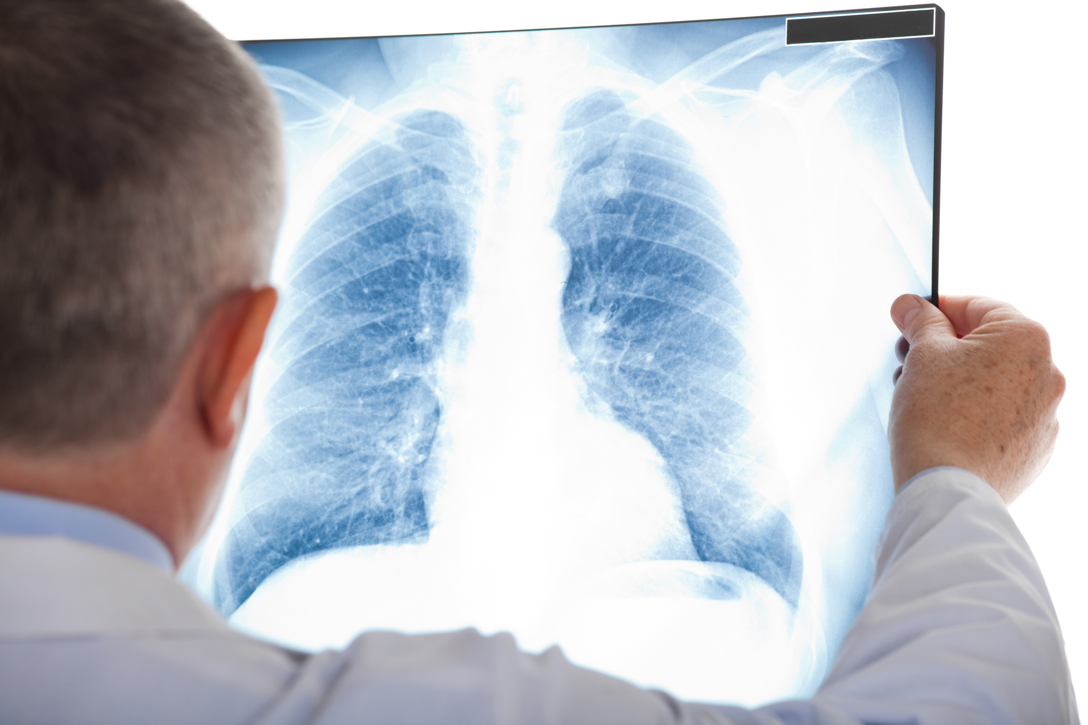 Un doctor examina una radiografia de pulmon